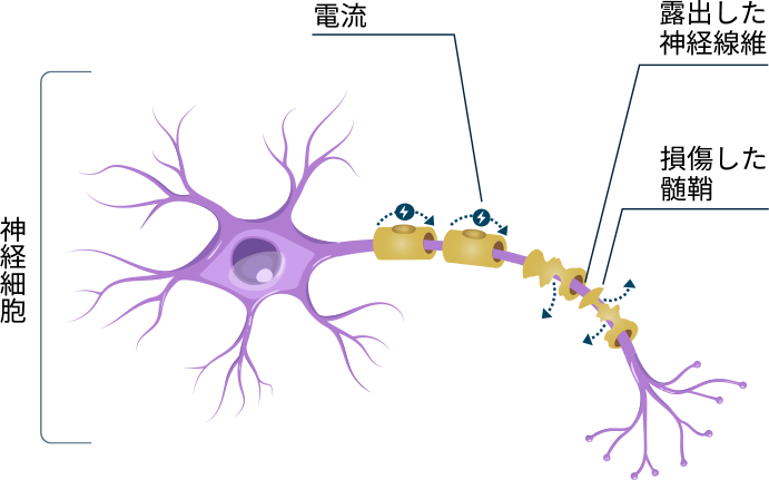 CIDPは末梢神経での脱髄により四肢筋力低下と感覚障害が生じる疾患です。