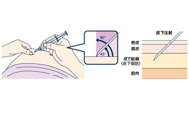 利き手で注射筒をもち、皮膚の「テント」の真ん中に注射針を４５度～９０度の角度で優しく刺します。